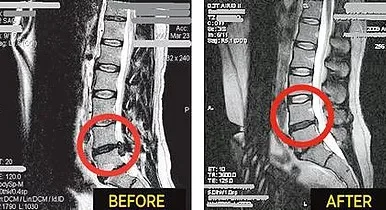 MRI images showing a lumbar disc herniation before and after spinal decompression therapy