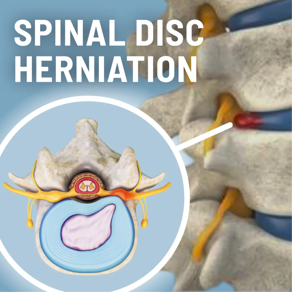 Herniated disc treatment in Orlando at Mattia Spinal Care & Rehab Center